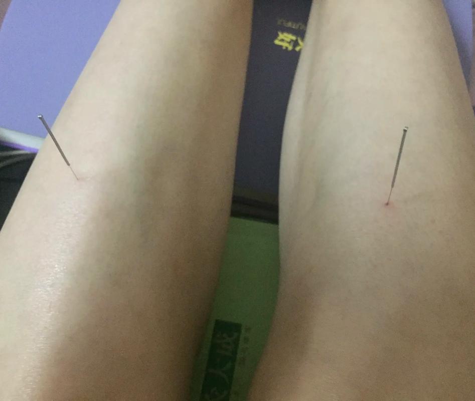 消化不好可以针灸吗