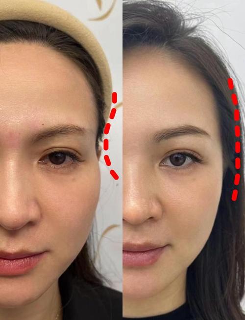 太阳穴打玻尿酸安全吗