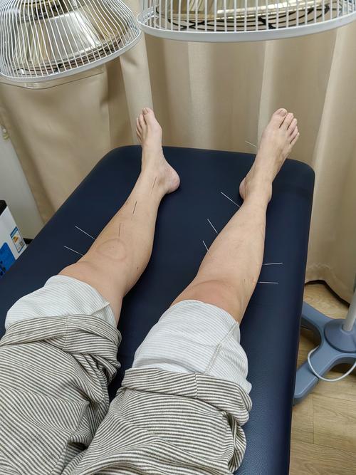 针灸治疗血小板减少