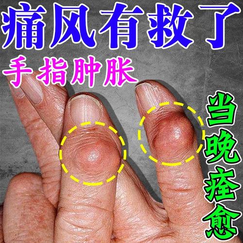 英太青治痛风多久起效