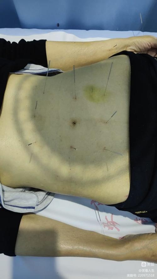 胃炎可以针灸治疗吗