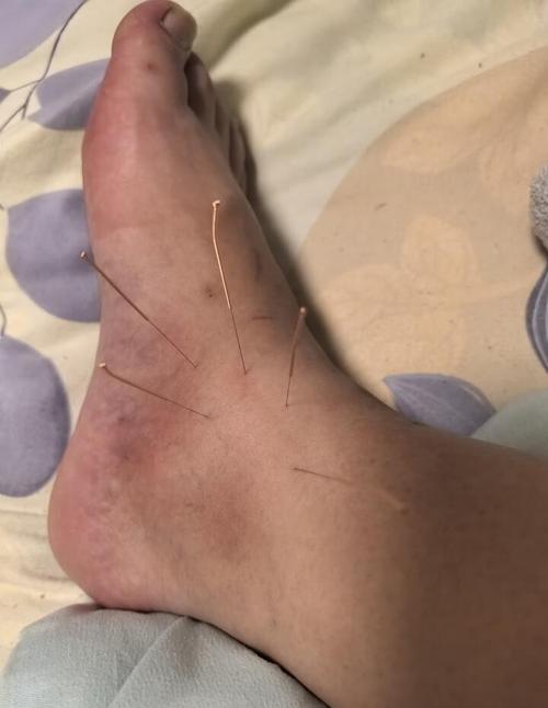 华佗夹脊可以针灸吗