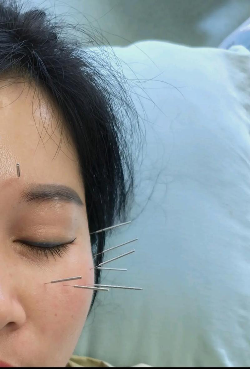 女生学中医针灸好么