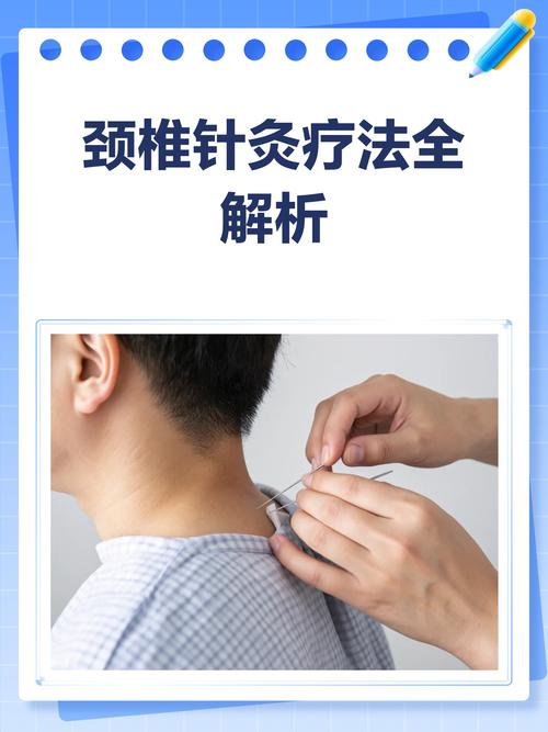 颈椎可以针灸治疗吗