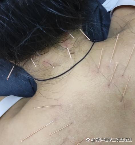 颈椎可以针灸治疗吗