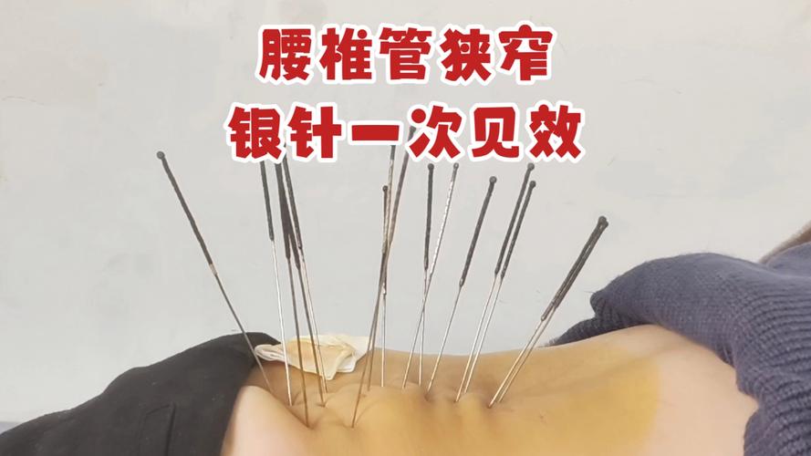 腰椎管狭窄针灸哪里