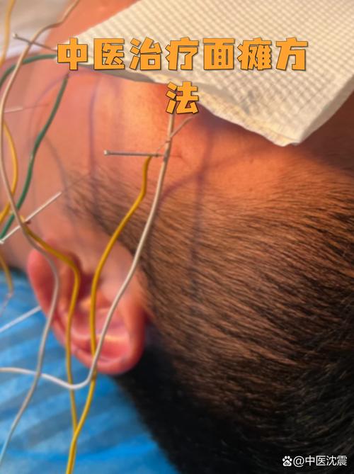 面瘫针灸先恢复哪里