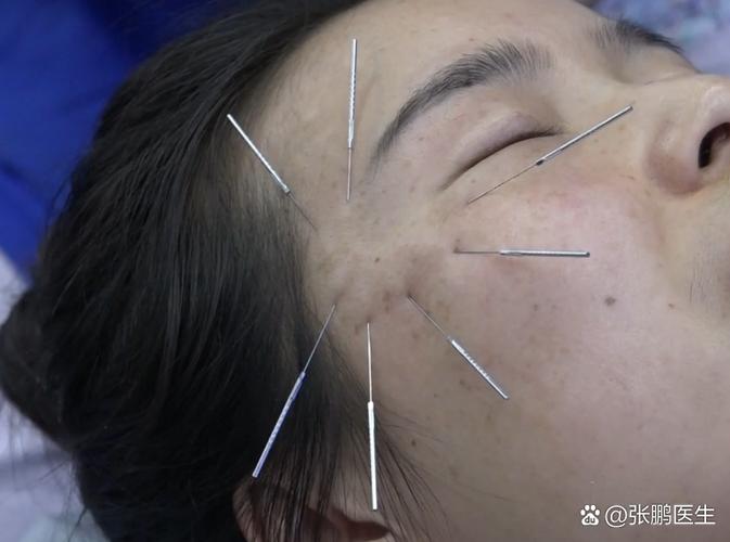 面瘫针灸先恢复哪里