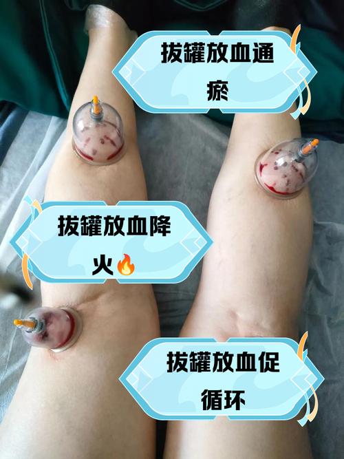 痛风拔罐放血疗法视频