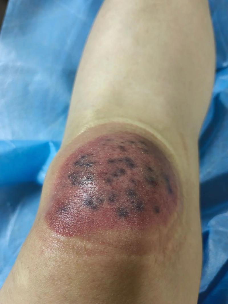 痛风拔罐放血疗法视频