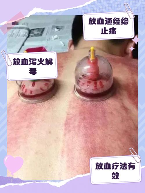 痛风可以拔罐放血疗法