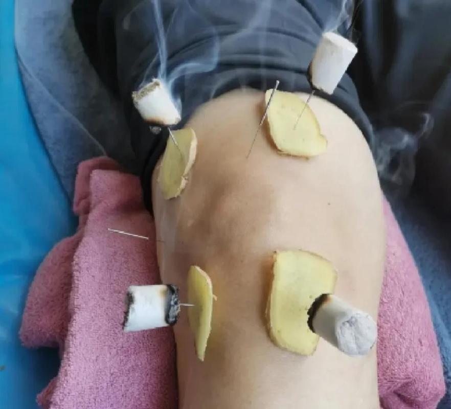 膝盖积液针灸扎哪里