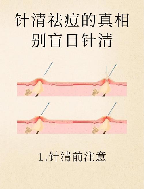 针灸治疗痤疮的方法