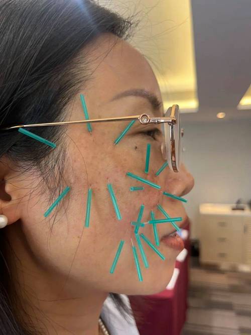 针灸治疗痤疮的方法