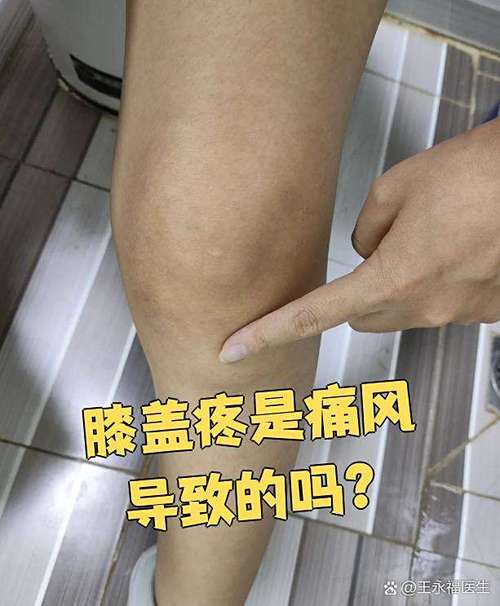 膝盖什么部位疼是痛风