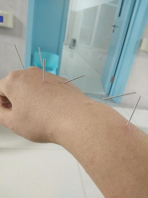 手上针灸的图片大全