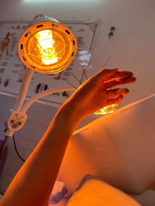 手上针灸的图片大全