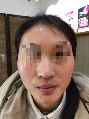 纽拉美斯玻尿酸安全吗