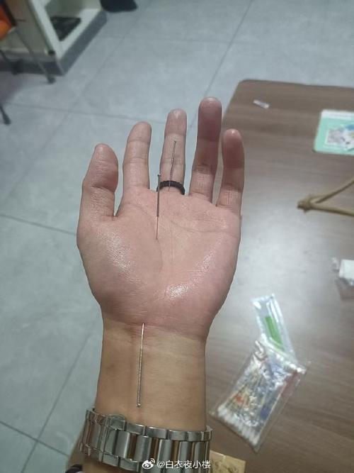 心脏不舒服针灸哪里