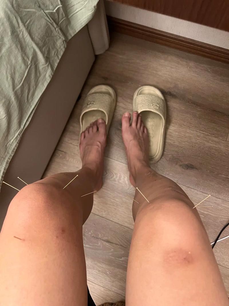 着凉腿疼可以针灸吗