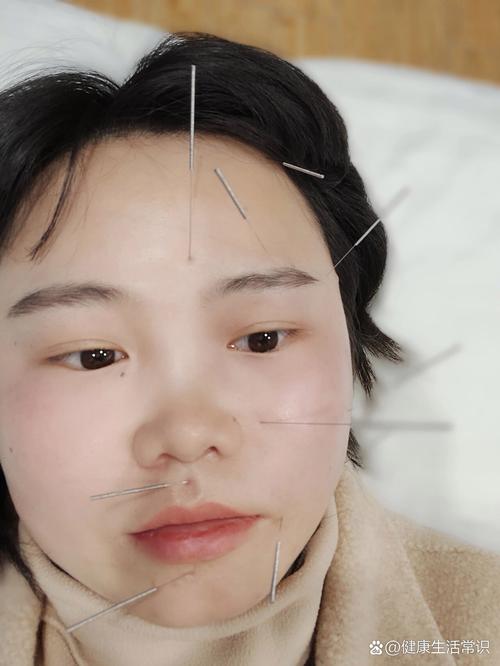 轻度面瘫可以针灸吗