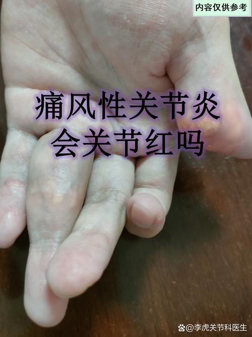 北京国康医院痛风好问