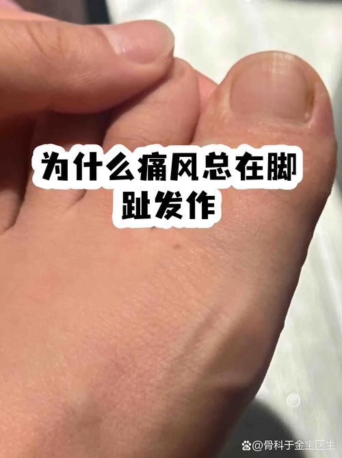 痛风为什么不能喝酸奶