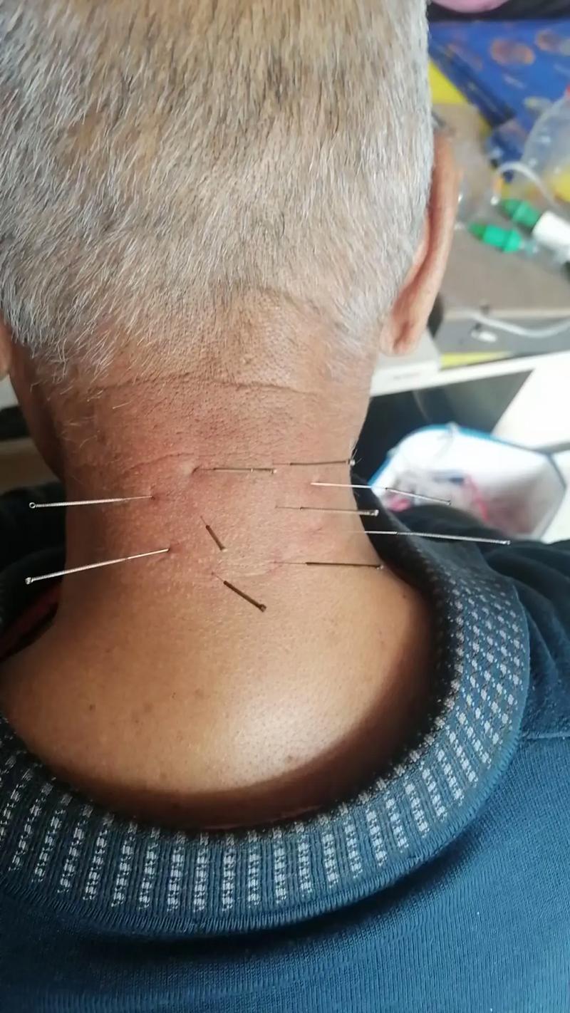 针灸可以治疗颈椎吗