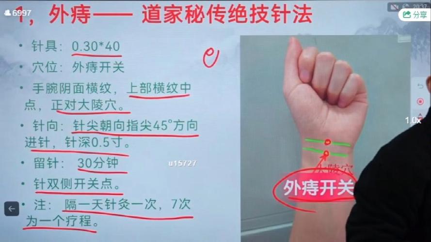 针灸治疗痔疮的原理