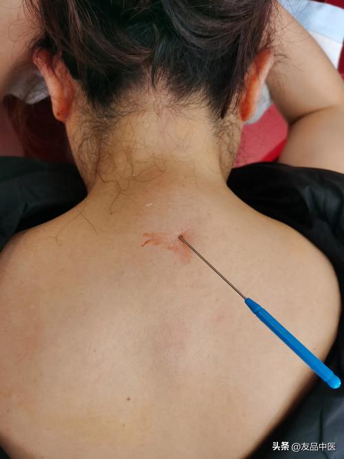 颈椎针灸后手臂酸痛