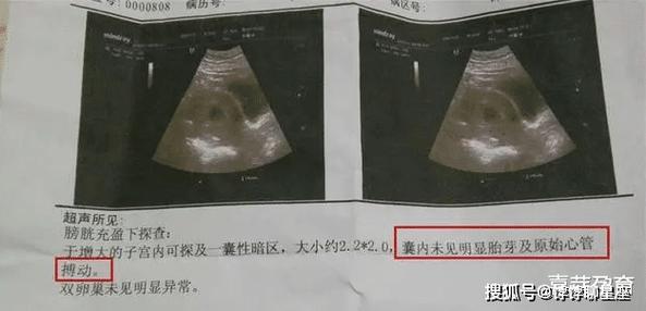 怀孕半个月打掉安全吗