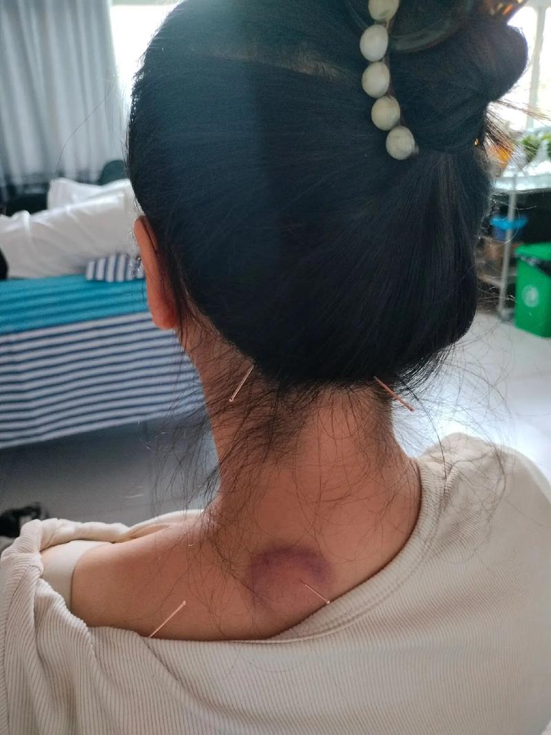 脖子僵硬可以针灸吗