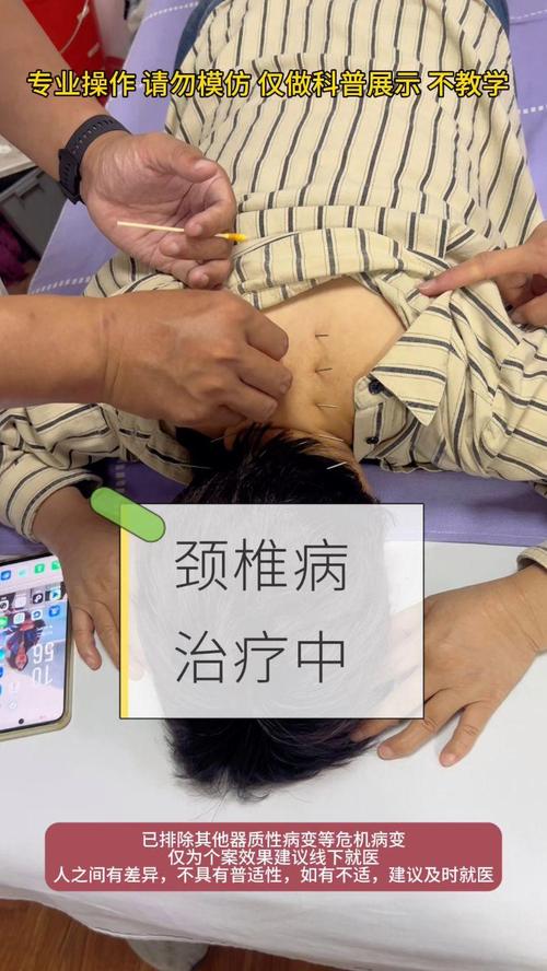 脖子僵硬可以针灸吗