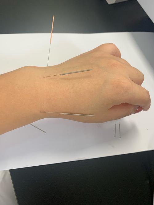 脖子僵硬可以针灸吗