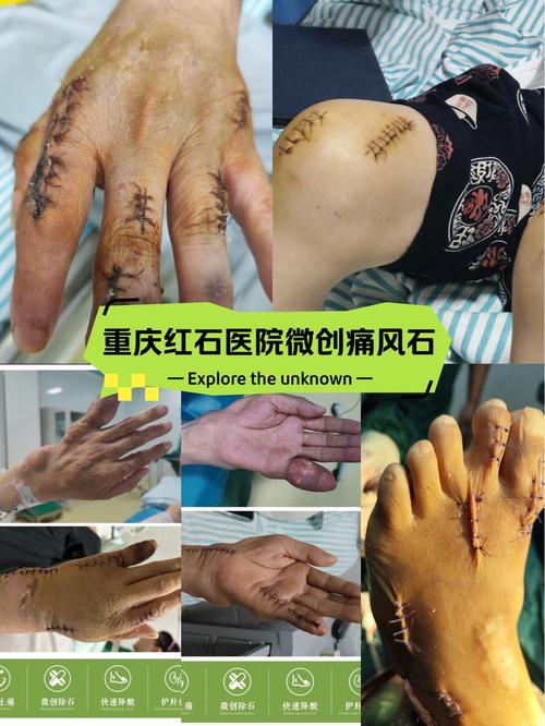 重庆痛风科九五丨推荐