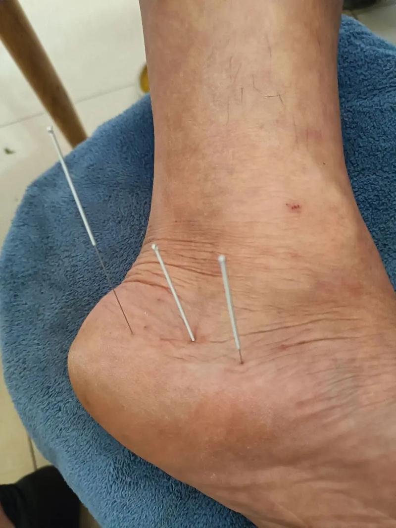 脚痛针灸可以治疗吗