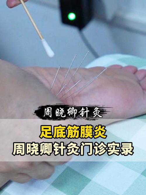 脚痛针灸可以治疗吗