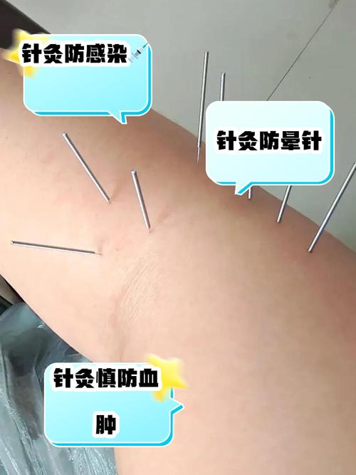 上虞针灸减肥的地方