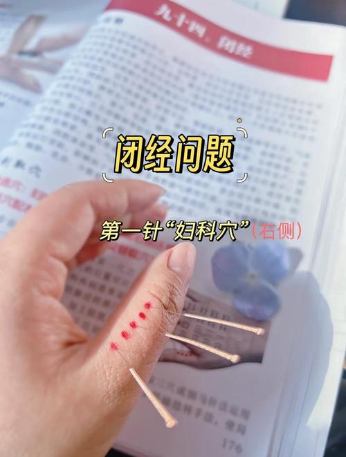 针灸治疗闭经有效吗