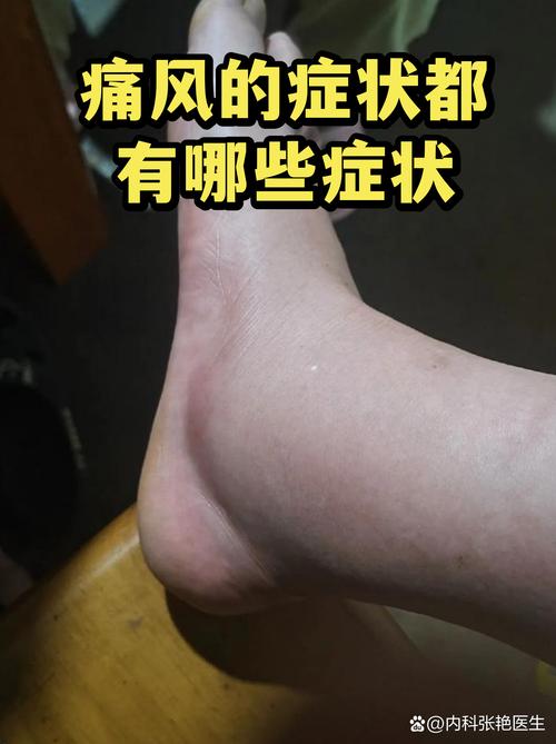 痛风尿检会有什么症状