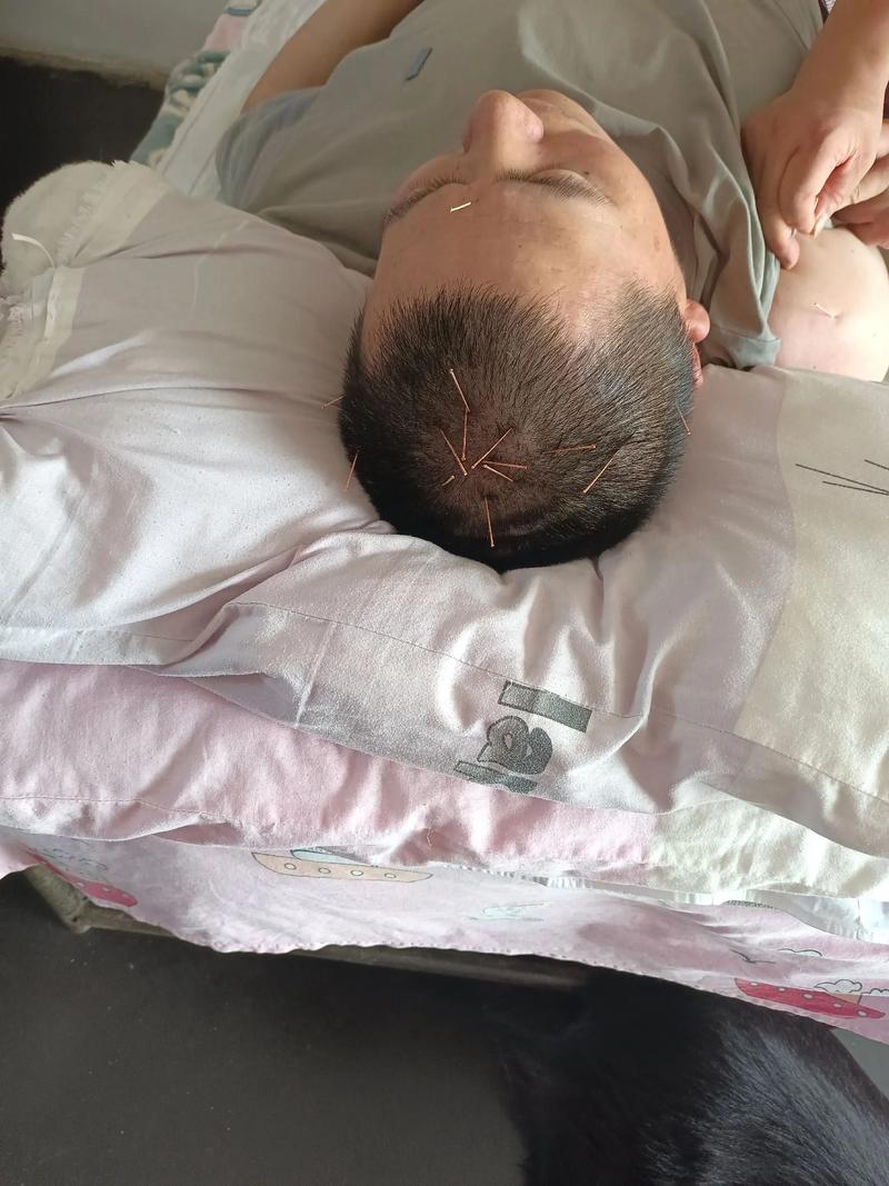 脑梗 针灸 副作用