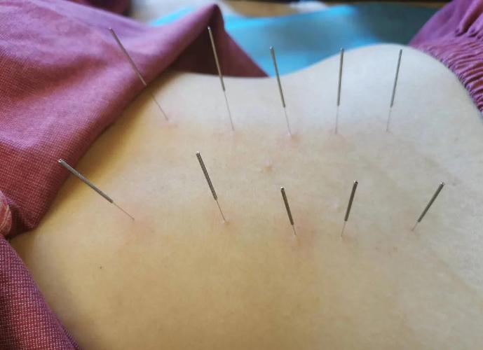 针灸治疗呼吸肌无力