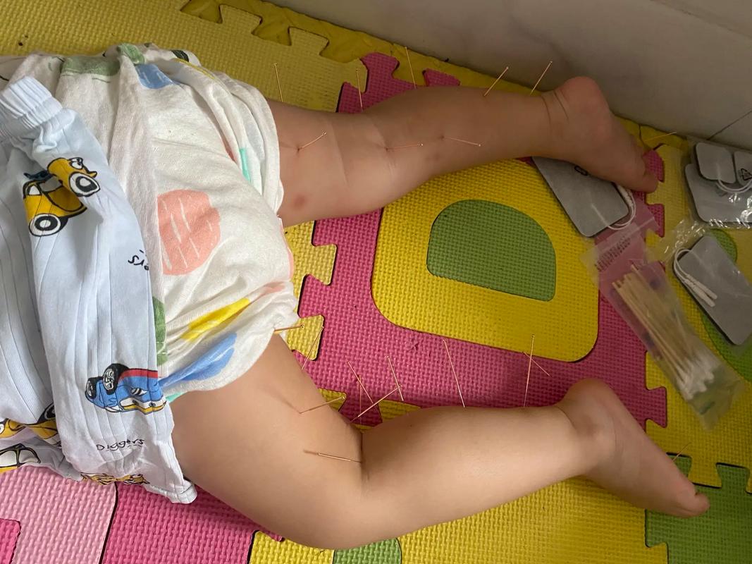 小儿脑瘫的针灸治疗