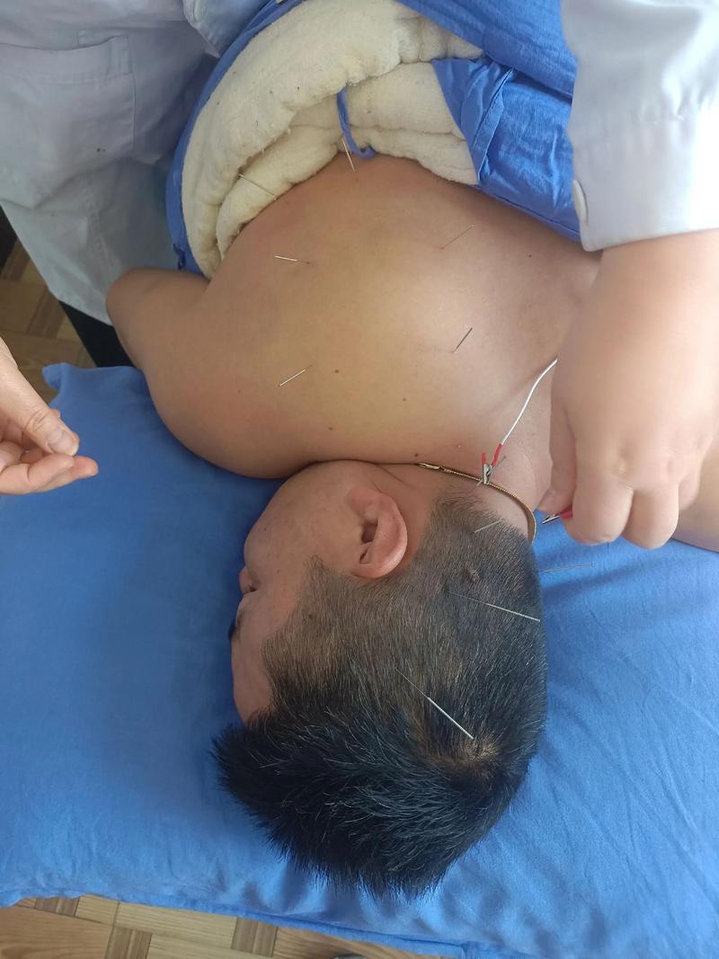 小儿脑瘫的针灸治疗