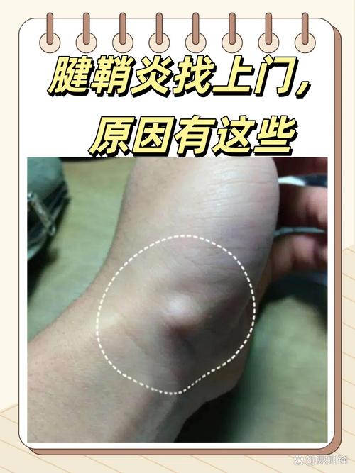 腱鞘炎和痛风有关系吗