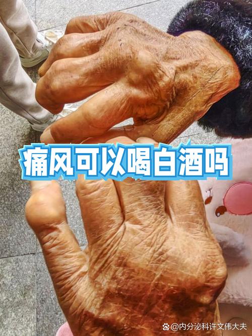 痛风喝二两白酒可以吗