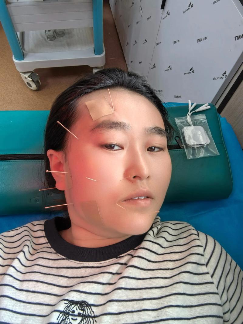 针灸可以治疗面瘫吗