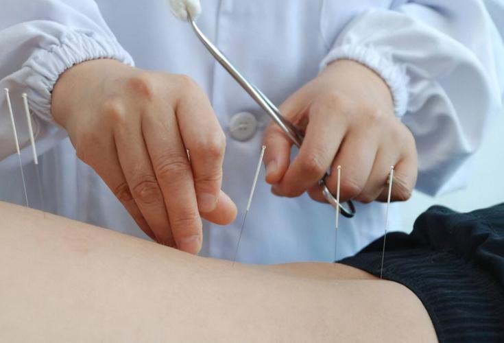 针灸对头晕效果好吗