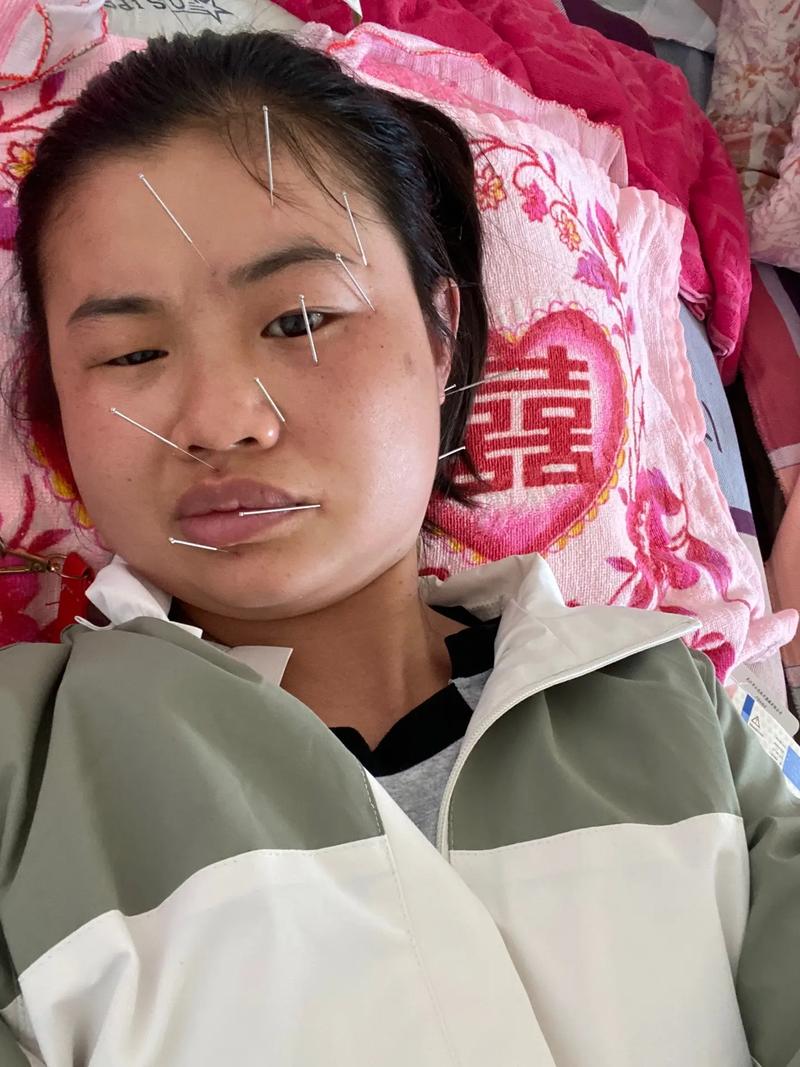 面瘫针灸后脸部僵硬
