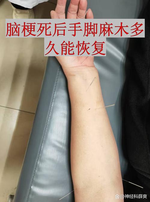 手臂麻木怎么去针灸
